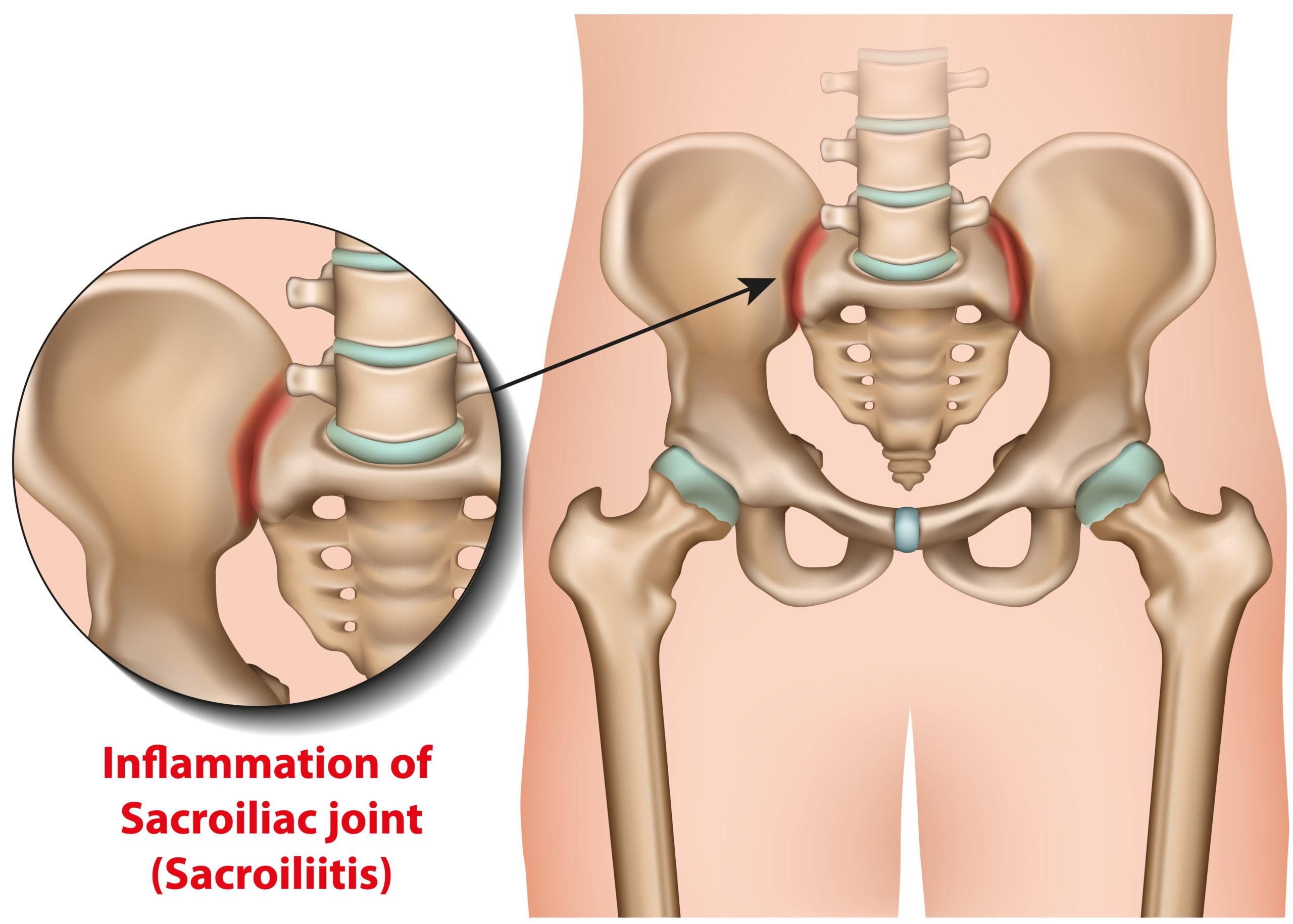 https://www.totalspinemn.com/wp-content/uploads/2022/08/sacroiliitis-treatment-maple-grove-scaled.jpg